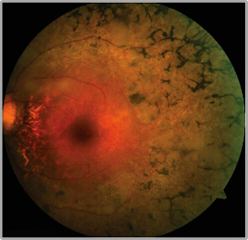 希瑪林順潮眼科中心_視網膜脫落_視網膜色素變性2
